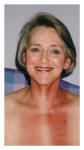 Burns healing well by day 17 after the 30 days of head and neck radiotherapy treatment.