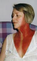 Picture of radiotherapy neck burns - 3 days after finishing radiation treatment.