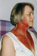 Photo  of neck burns  post radiotherapy 3 days after treatment finished.