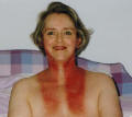 Photo  of  post radiotherapy neck burns 7days after treatment finished