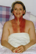 Photograph  of neck burn  9 days after radiation treatment finished.