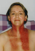 Photo  ofpost radiotherapy  neck burns  10 days after treatment finished.