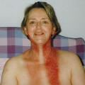 Photo  of neck burn  post radiotherapy - 12 days after treatment