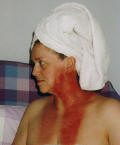 Post radiotherapy burns 11days after radiotherapy finished.