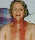 Neck burn pictures 14 days after radiotherapy finished