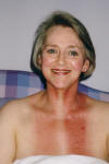 Radiation burns - Photograph of radiotherapy neck burns 17 days after completion of radiotherapy cancer treatment.