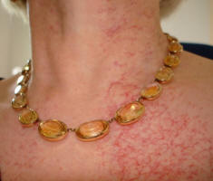 Long term after effects of radiotherapy burns at 4 years - Click to enlarge to see the full extent of the red vein damage caused by cancer radiation treatment.