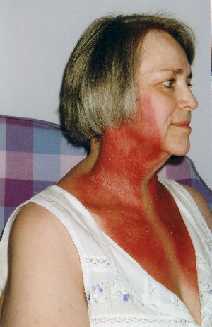 Red skin on neck and upper chest - Dermatology - MedHelp